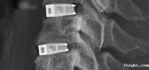 EIT_implant_1